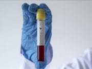 Lukavac: Koronavirus potvrđen kod dvije osobe